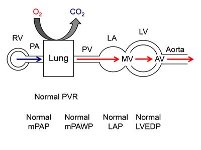 Pulmonary Hypertension in Aortic and Mitral Valve Disease